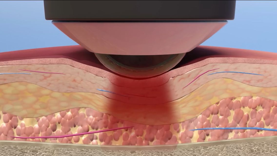 Cold laser therapy